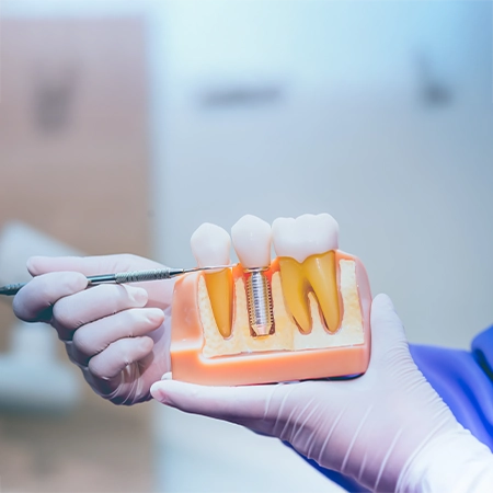 Example Cutaway Of Dental Implants